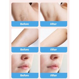 جهاز إزالة الشعر بتقنية IPL للاستخدام المنزلي IPL Hair Removal Device – At-Home Use