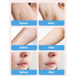 جهاز إزالة الشعر بتقنية IPL للاستخدام المنزلي IPL Hair Removal Device – At-Home Use