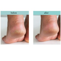 كريم عناية بالقدم Healing Foot Spa Cream