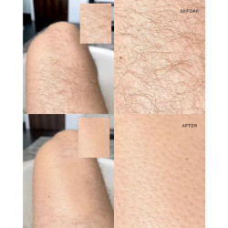 أداة إزالة الشعر بالتقشير Exfoliating Hair Removal Drop