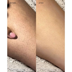 أداة إزالة الشعر بالتقشير Exfoliating Hair Removal Drop