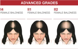 امبولات علاج تساقط وانبات الشعر للنساء 1300 Hair Loss and Growth Treatment Ampoules for Women 1300