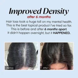 سيروم علاج فروة الرأس لتساقط الشعر Scalp Treatment Serum for Hair Loss