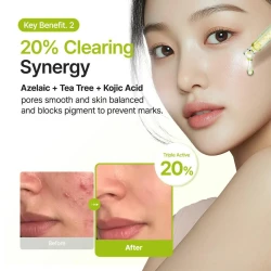 سيروم للوجه بحمض الأزيليك 10% بالكوجيك وشجرة الشاي 30 مل Azelaic Acid 10% Kojic Tea Tree Facial Serum 30ml
