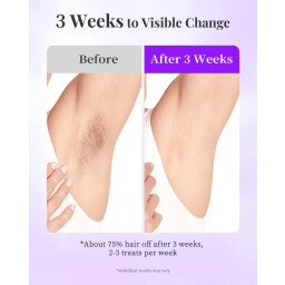 جهاز إزالة الشعر IPL سافير الياقوت بتبريد احترافي منزلي Sapphire IPL Hair Removal Device with Professional Cooling for Home Use
