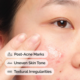 سيروم الألوفيرا 2% + NAG 2% – لعلاج الحبوب وآثارها وتهدئة البشرة Aloe 2% + NAG 2% Solution – Acne Care & Skin Soothing Serum
