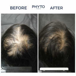 امبولات سيروم لتساقط الشعر التدريجي للنساء 12×5 مل Densifying Hair Serum For Women – 12 Vials x 5 ml – For Progressive Hair Loss