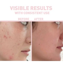 بايونكس ساليسيلك اسد سيرم 30 مل Bionnex The Nordea Purifying Salicylic Acid Serum 30 ml