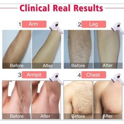 إيمني جهاز إزالة الشعر بالليزر imene lazer Hair remover