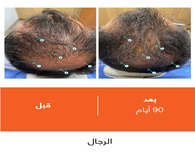بلسم ريفيتا REVITA HIGH-PERFORMANCE HAIR DENSITY CONDITIONER