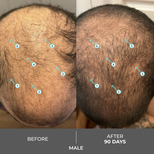 شامبو ريفيتا اكسترا للرجال والنساء الذين يعانون من تساقط الشعر Revita Extra Strength Hair DENSITY Shampoo