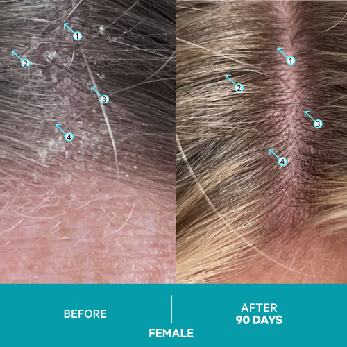 شامبو داندرين المضاد للقشرة Dandrene Exfoliating Anti-Dandruff Shampoo